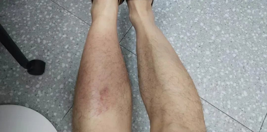 雨天一个动作，男子竟染上这种病