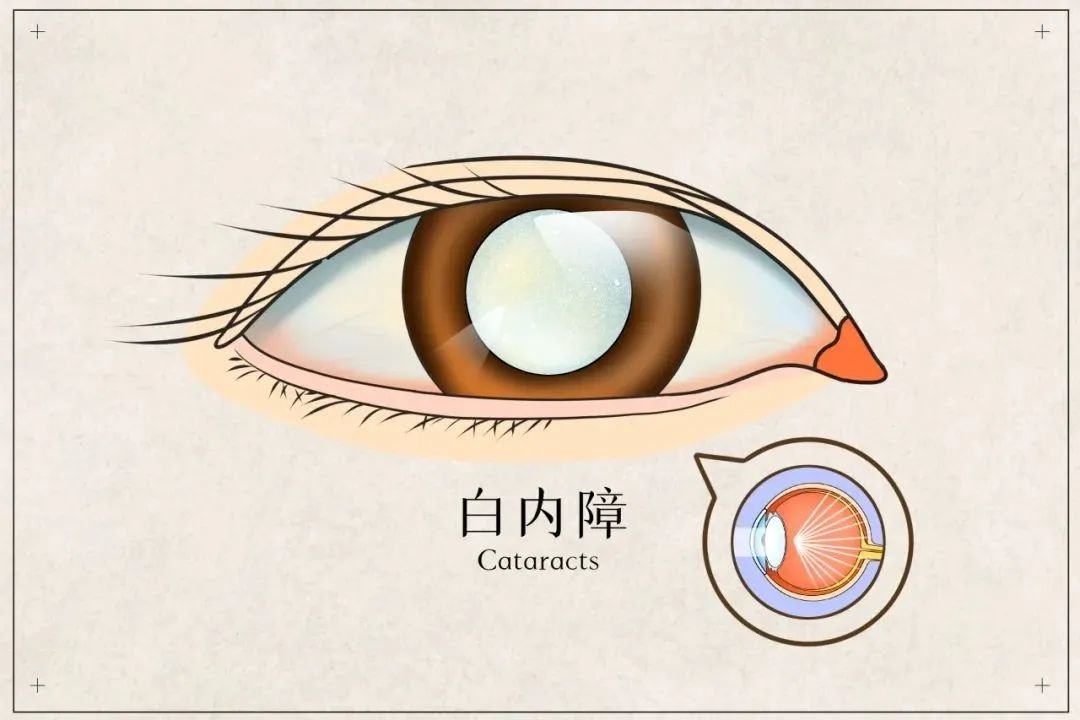出现这些症状，需警惕白内障︱科普时间