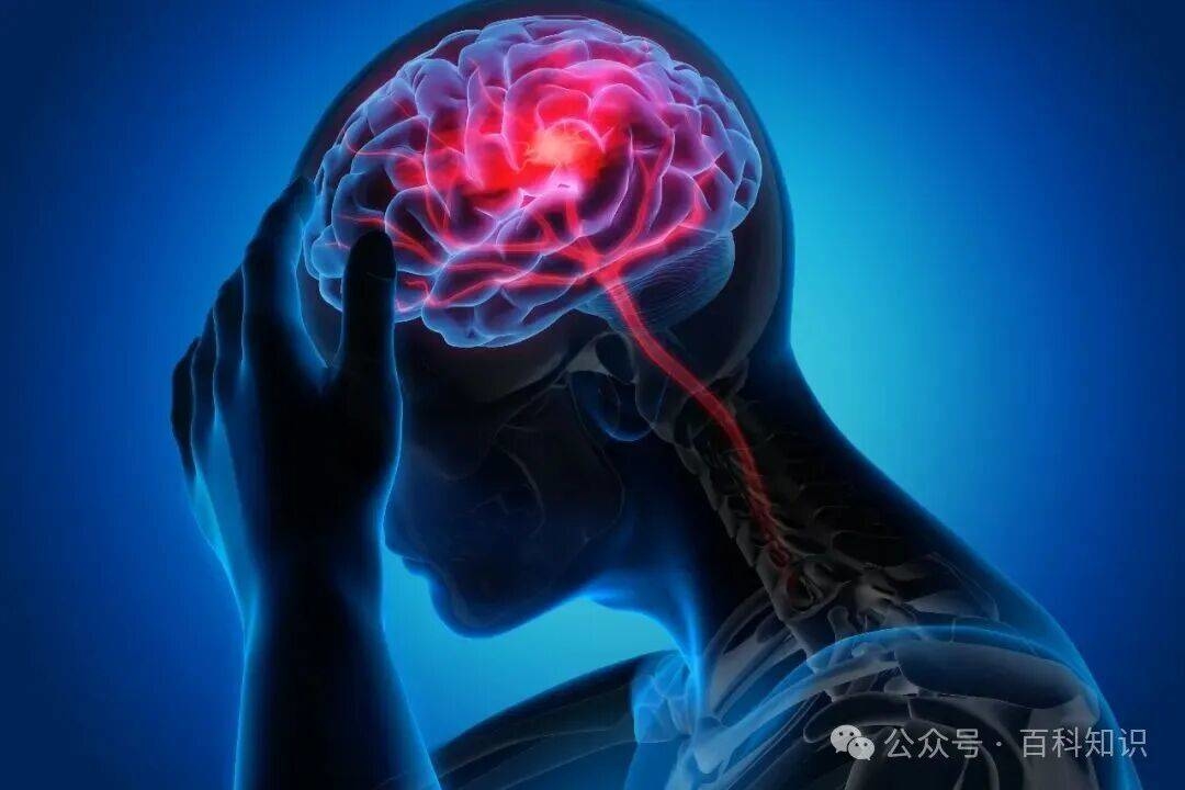 百科知识丨别让误判关上脑卒中的时间窗 （上）
